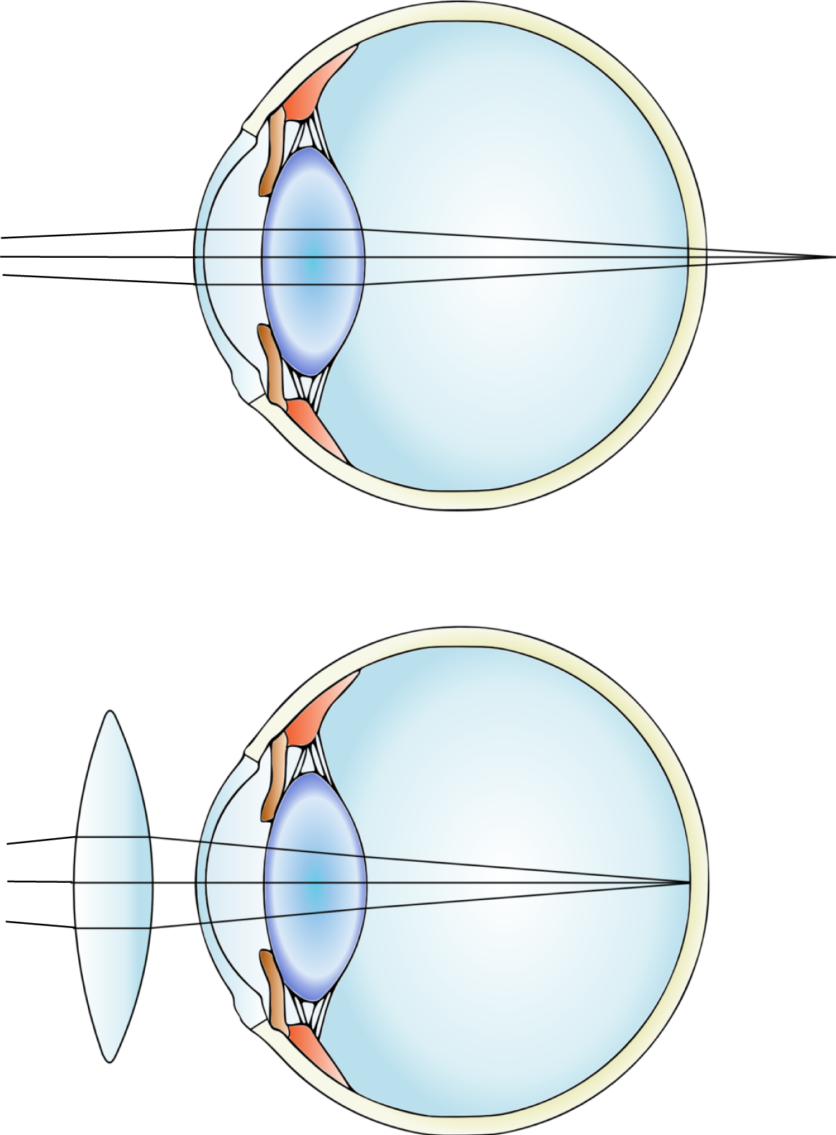 long-sight diagrams and correction with lens