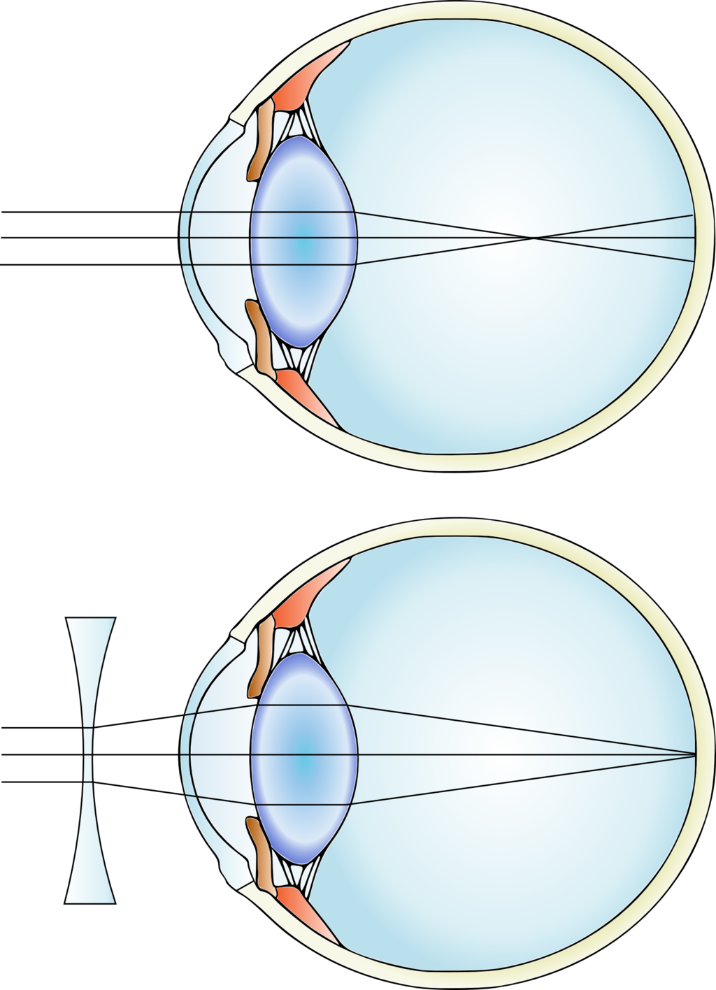 myopia diagrams and correction using lens