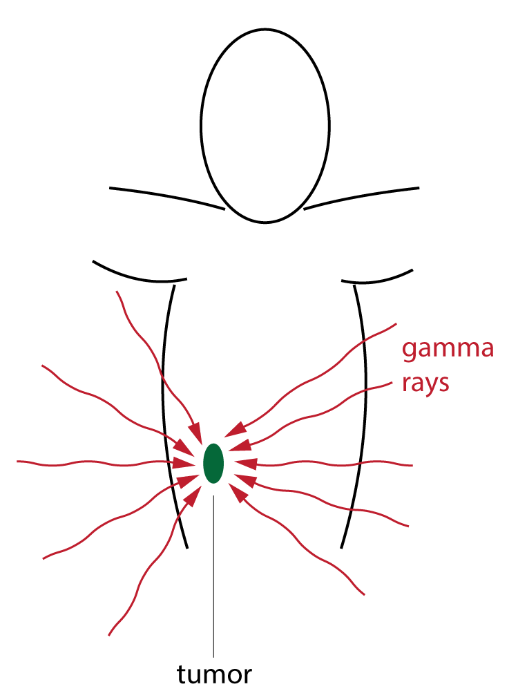 radiotherapy diagram